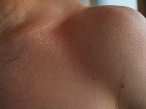 What are Skin Tags? 