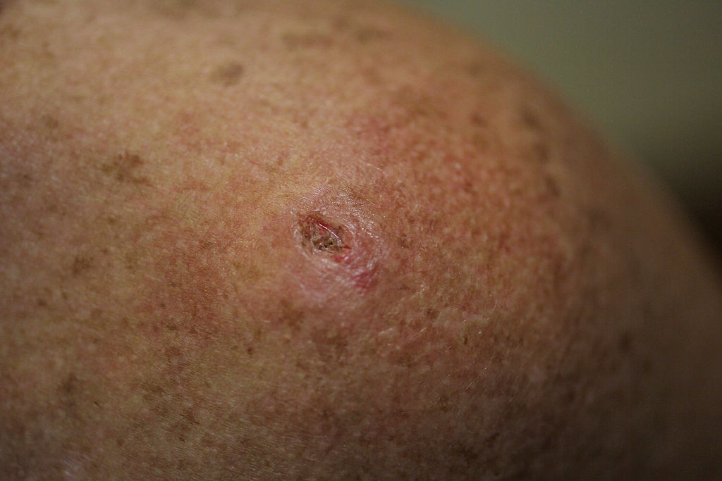 What Does Skin Cancer Look Like Beauty World News