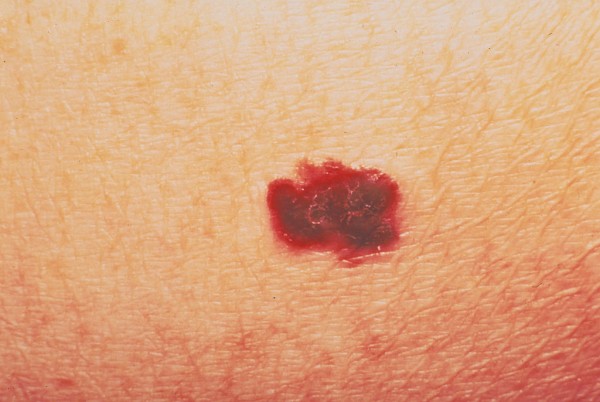 What Does Skin Cancer Look Like?