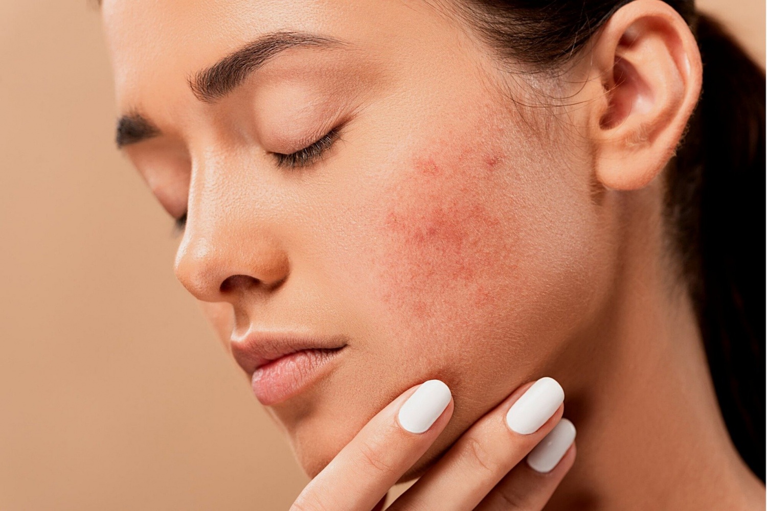 How To Get Rid Of Dark Marks From Acne Breakouts