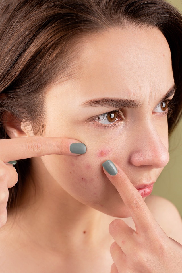 Understanding Adult Acne