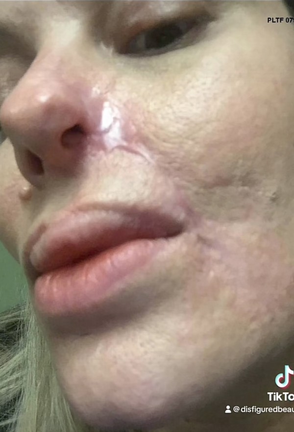 Woman - botched fillers