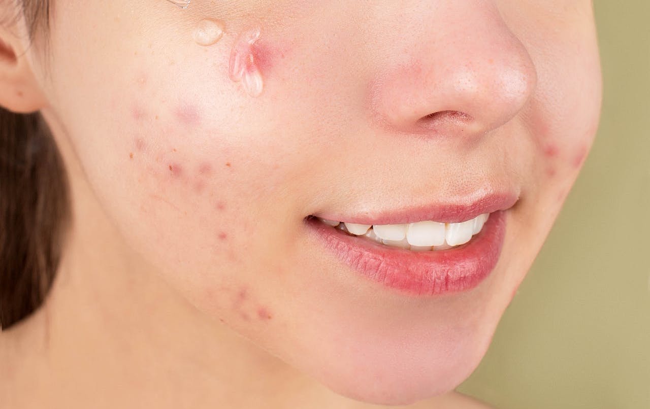 acne marks 
