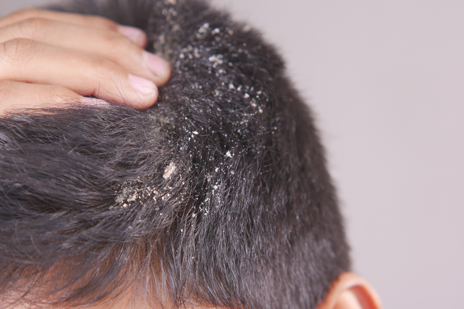 Dandruff: Causes and Lifestyle Changes That May Help