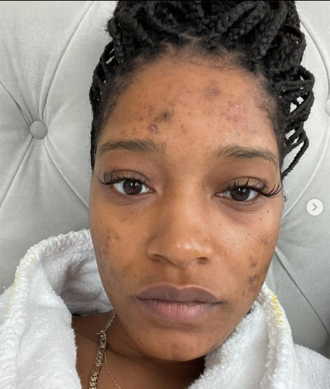 Keke Palmer Gets Candid About Acne and Polycystic Ovary Syndrome